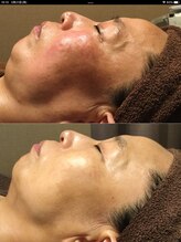 ドクターピュールボーテ 神戸店(Dr. PUR BEAUTE)/シミケア