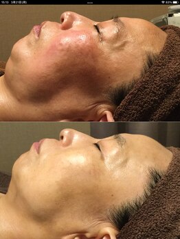 ブリエールラミール/シミケア