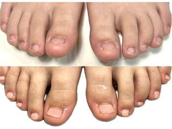 グレースレディ/(深爪/長さだし/フィルイン/)