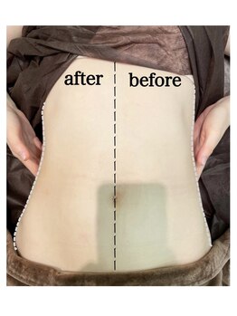 エンチャント(ENCHANT)/お腹くびれ超音波リフト