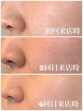 エスポワール(espoir)/ハーブピーリング症例