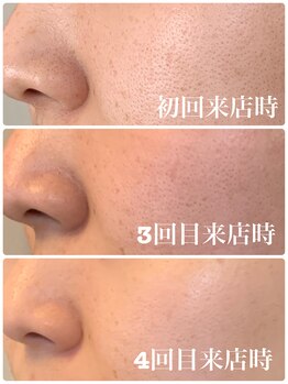 エスポワール(espoir)/ハーブピーリング症例