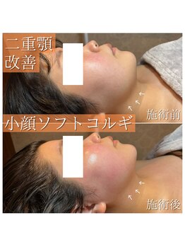 ツルル 岡崎店(TSURURU)/【小顔ソフトコルギ】