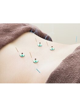 鍼灸施術を受けたい