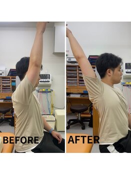 シナプスケアセンター 十三院(SYNAPSE CARE CENTER)/【シナプス療法】で肩の動きが！