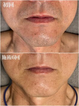 ルシャトン(Le Chaton)/ヒゲ脱毛