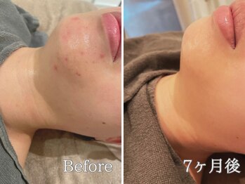 ポポラス(POPOLUS)/しつこいあごのニキビケアも☆