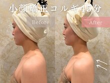 ドレッサー 福岡香椎店(DRESSER)/【症例】小顔コルギ1回の結果