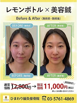 ひまわり鍼灸接骨院の写真/すっきりフェイスライン！美容鍼×レモンボトルで理想の自分へ