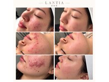 ランティア 大阪梅田南森町(LANTIA)の雰囲気（【大阪天満宮/ピーリング/毛穴】ニキビ改善やツヤ肌育成が得意◎）