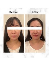 ザビューティー 麻布十番本店(The Beauty)/12Dリフト全顔打ち放題[リフト]