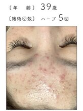 ノーブル 新宿南口(NOBLE)/ハーブピーリング専門新宿