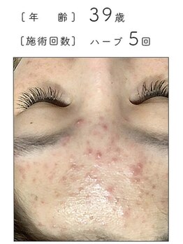 ノーブル 新宿南口(NOBLE)/ハーブピーリング専門新宿