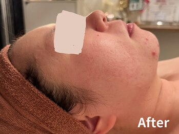 ダイヤモンド リーエンダ(Diamond leende)/クレイハーブピーリング