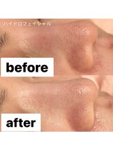 リンダ 西宮店(LINDA)/ハイドロフェイシャル