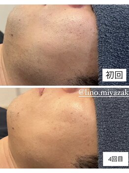 リノ(LINO)/LINOのヒゲ脱毛