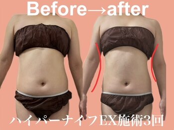エステサロン ヴリエ 立川店/★ハイパーナイフEX120分★3回