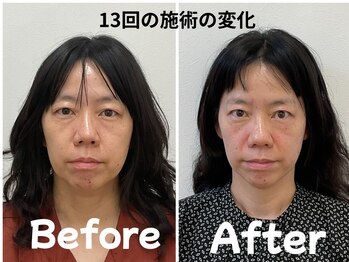 ゆず鍼灸整骨院/当院人気NO1！美容鍼モニター様