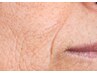 30～50代【肌のハリ/しわ改善/くすみ肌】グロッティープロで幹細胞美容液導入