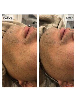 ナチュラル シャイン(NATURAL SHINE)/ヒゲ脱毛1回目