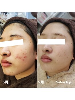 ビーピー 渋谷(b.p.)/ニキビケア ハーブピーリング