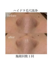サラ/ハイドラ毛穴洗浄