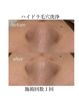 サラ/ハイドラ毛穴洗浄