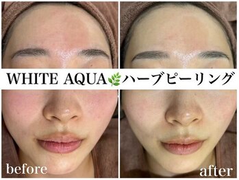 ホワイトアクア 姫路店(WHITE AQUA)/ハーブピーリング/姫路/肌荒れ