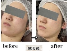 ワクシングアンドビューティーワイ(Waxing&Beauty_Y)/【特許取得】高濃度炭酸パック