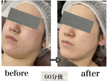 ワクシングアンドビューティーワイ(Waxing&Beauty_Y)/【特許取得】高濃度炭酸パック