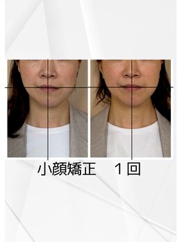 めいてる/小顔矯正1回で顎の歪みが変化☆