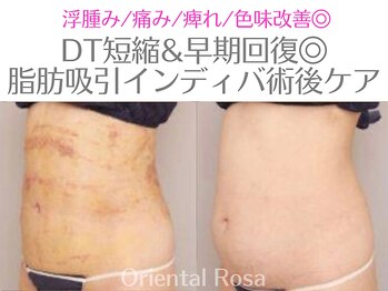 オリエンタルローザ 表参道(Oriental Rosa)/お腹脂肪インディバアフターケア