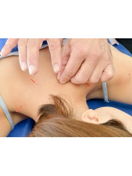 鍼灸施術を受けたい