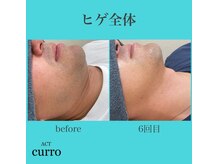 アクト クロ(ACT curro)/【ヒゲ全体】脱毛施術例