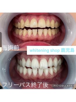 ホワイトニングショップ 鹿児島店/#鹿児島ホワイトニング