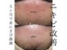 【徹底ニキビ改善】REVIハーブピーリング+ニキビケアOP+再生因子導入¥22000→