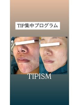 ソリッジ肌管理室/TIPハーブピーリング