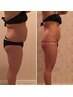 【本気痩身Before→After】人気マシン×集中アプローチ40分★変化実感コース