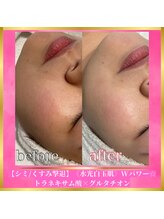 アイリープ(eyeleap)/☆【シミ/くすみ撃退】