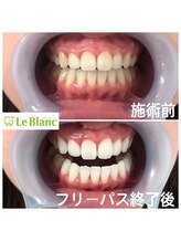 ルブラン 奈良店(Le Blanc)/黄ばみ本当に大丈夫？？