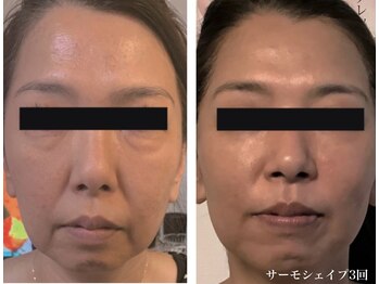 Nビューティー/最新RFサーモシェイプオーパス