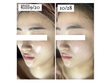 ホワイトアクア つくば店(WHITE AQUA)/ハーブピーリング/毛穴ケア/茨城