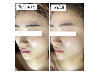 ホワイトアクア つくば店(WHITE AQUA)/ハーブピーリング/毛穴ケア/茨城