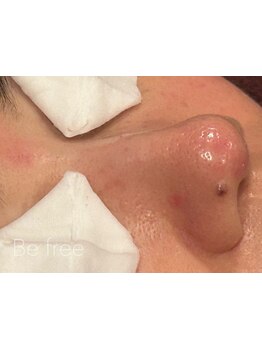 毛穴ケアをしたい