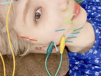 恵比寿すこやか鍼灸整骨院の写真/【恵比寿駅徒歩2分♪】フェイシャルケアに美容鍼は試しましたか？小顔・ほうれい線・たるみ改善に◎