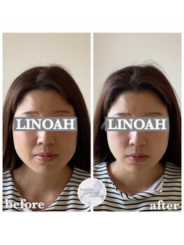 リノア 心斎橋店(LINOAH)/ウルトラプラス小顔リフト b→ a