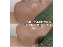 リモナ(Re-mona..)の雰囲気（本気の肌質改善が叶う“REVIハーブピーリング” 剥離なし◎）