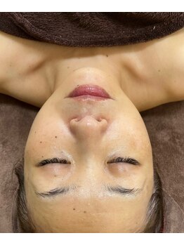 ミーレ アンド コッソリ(Miele&kosori)/エステ版ポテンツァで肌管理！