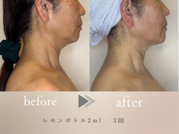 グロッシー(glossy)/【症例】レモンボトル顎下50代