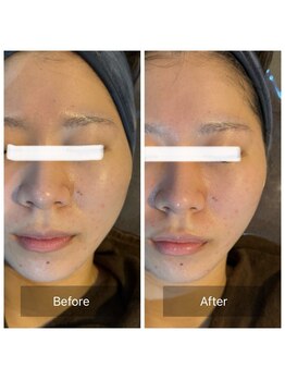 ラビ(RABBI)/20代女性レモンボトル×小顔